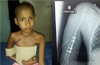 Complex surgery by  Unity doctors; Arm of 10 yr old cancer patient saved